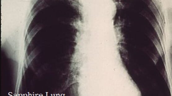 Screenshot Sapphire Lung